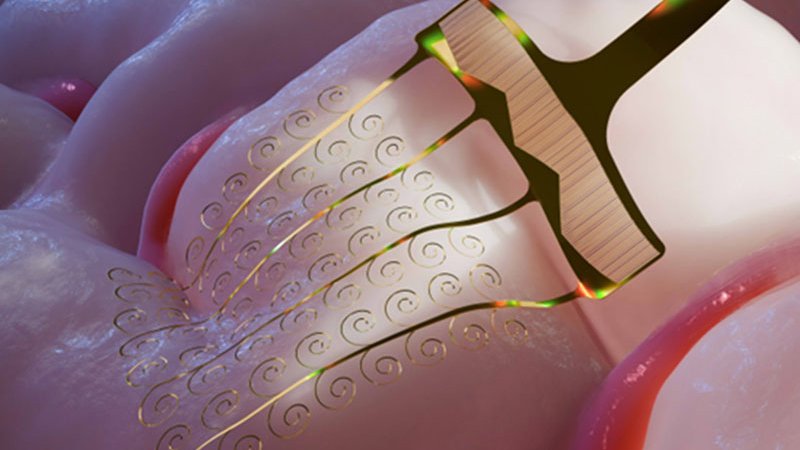микроэлектроды, нейроинтерфейс, мозг, имплантация, нейротехнологии