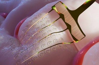 микроэлектроды, нейроинтерфейс, мозг, имплантация, нейротехнологии