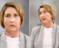 Лицо, пересадка, эвтаназия