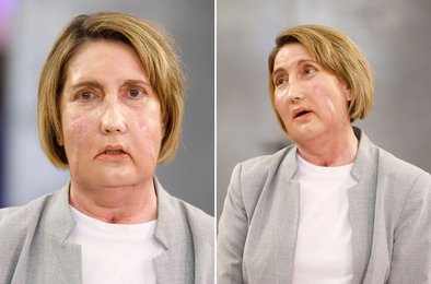 Лицо, пересадка, эвтаназия