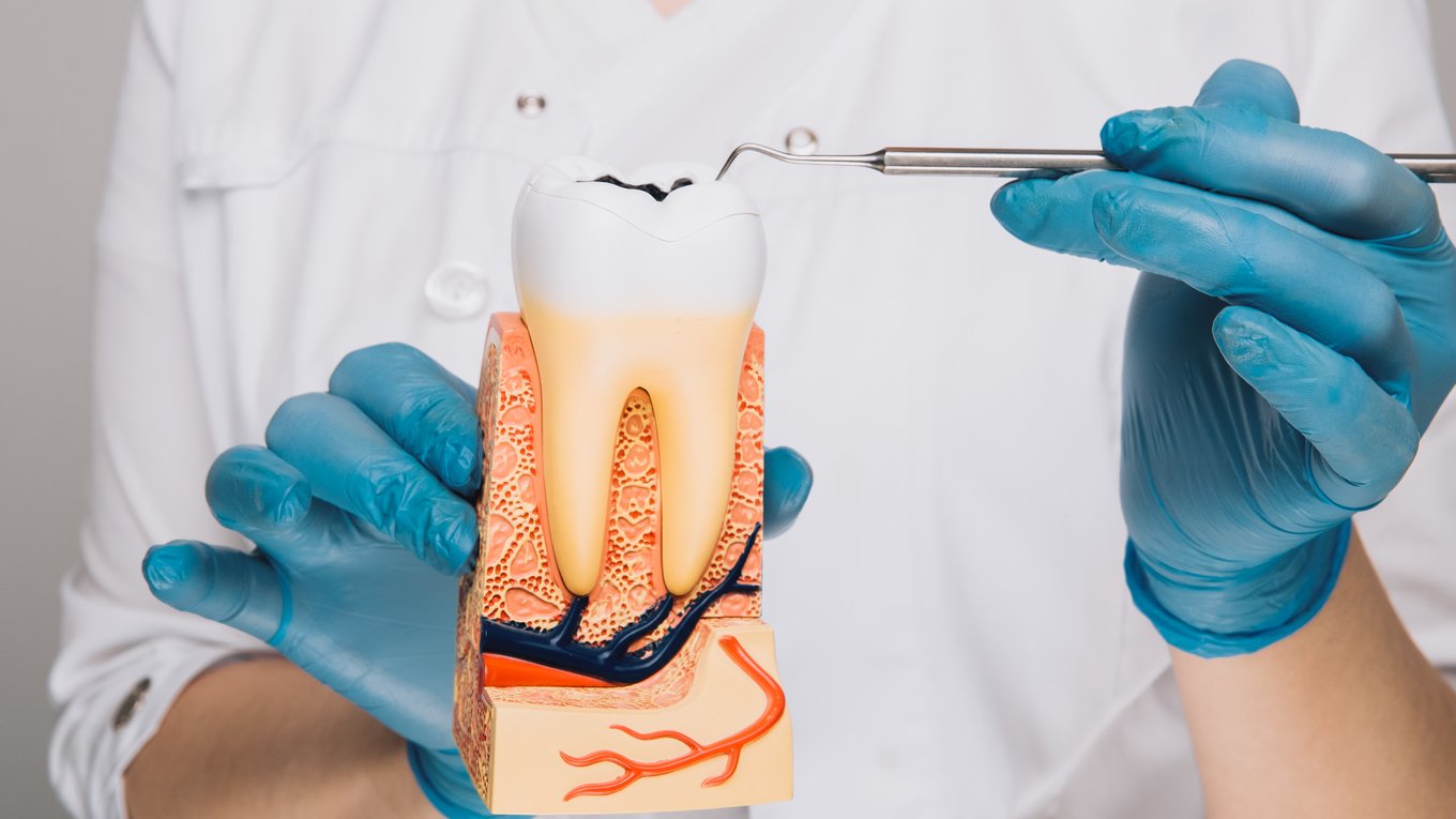 кариес, наклейка, стоматология, лечение, технология